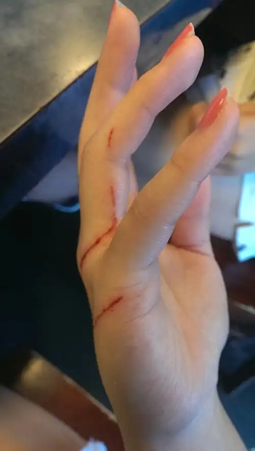 女孩子在手上留疤不好看啊. 有没有一些天然的东西能帮助不留疤?