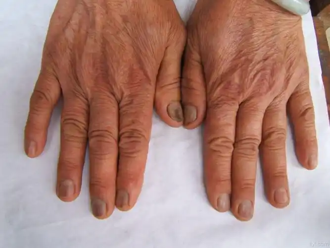 你看这些指甲是什么病