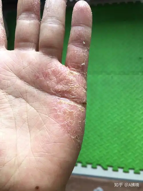 湿疹银行汗疱疹近期治疗效果