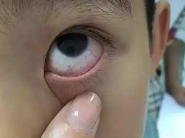 获得性风疹前驱期眼睛有红血丝图