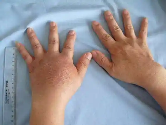 如过敏性皮炎,脂溢性皮炎,神经性皮炎等,杭州肤康皮肤病医院专家指出