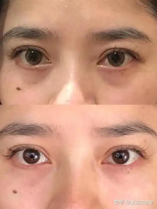 泪沟填充的材料怎么选?