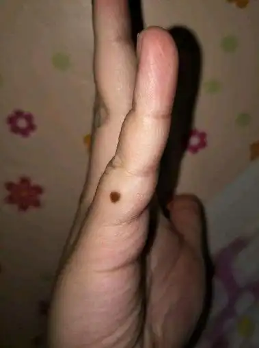 小指有痣的人:对别人很热情,性格很开朗,乐于助人.