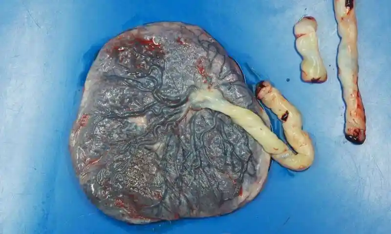 重磅美国西北大学医学院covid19会损伤孕妇的胎盘可能对胎儿有影响