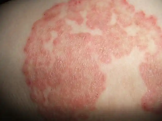 导致湿疹疾病发生的原因