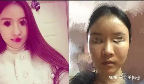 面部多少有点凹陷的当时在手机上看到这家医院脂肪填充案例,当时觉得