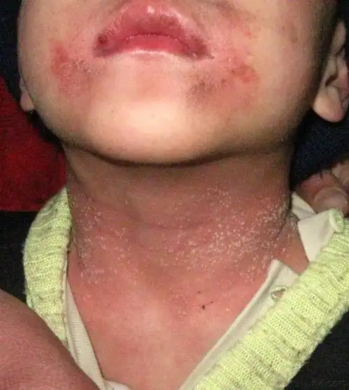 颈部皮疹求助 - 皮肤及性传播疾病讨论版 - 爱爱医医学论坛