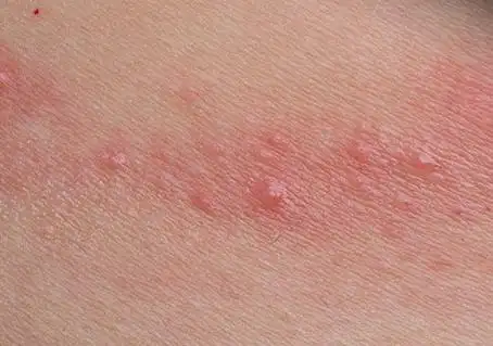 常见皮肤病图片及名称接触性皮炎