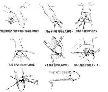 品牌男科 生殖整形 包皮包茎 > 包皮过长一定要做包皮手术吗?