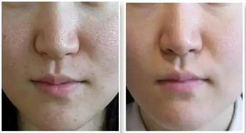 收缩毛孔效果对比