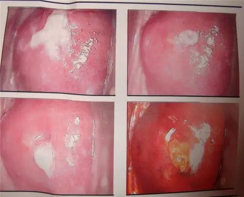 霉菌性阴道炎瘙痒难忍白带呈豆腐渣状