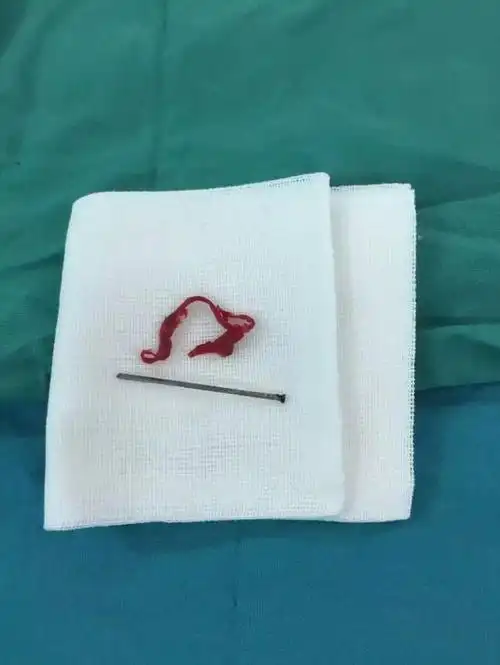 术后取出的钉子