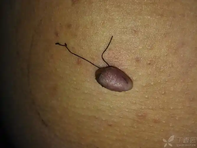 大腿根部背侧带蒂瘤子切除后的疑问