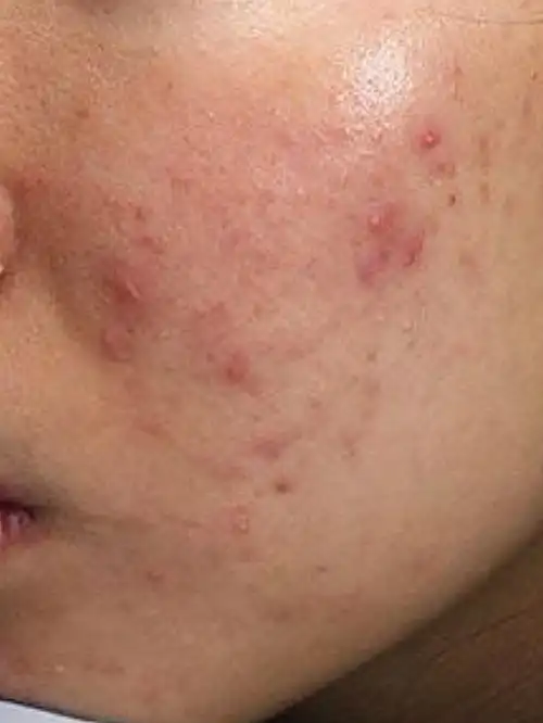 这位患者经面诊是痤疮,脂溢性皮炎,曾经应用可疑含激素护肤品,皮肤