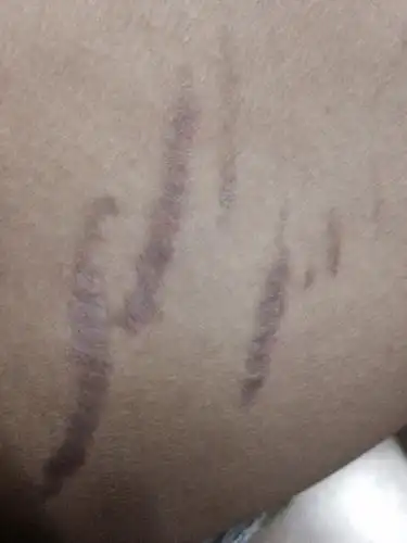 大腿内侧怎么了?黑色一条条