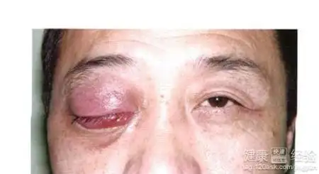 耳真菌病的病因