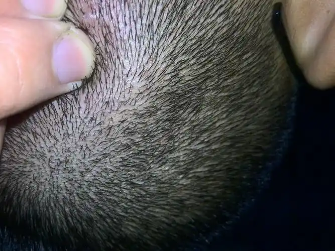 别人的头发不是一个毛孔里长一根头发啊?难道我有什么特