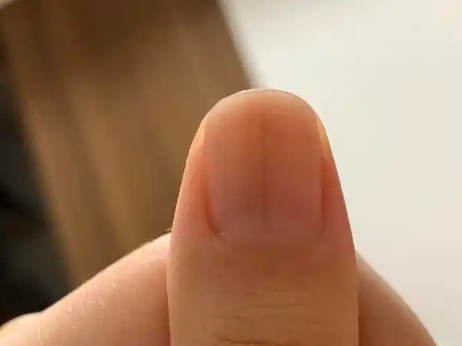 指甲有两条竖线是正常的吗