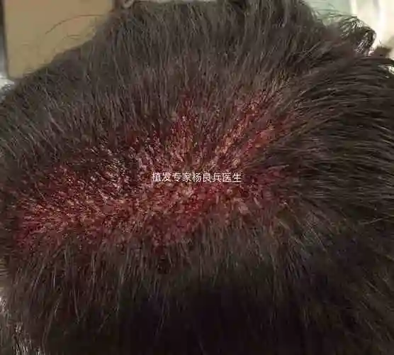 拔毛癖及其治疗