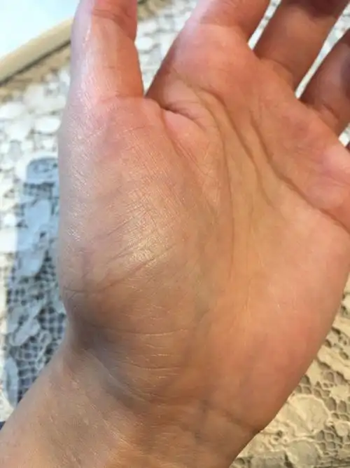 手掌青筋多大鱼际青筋偏多感觉还发青