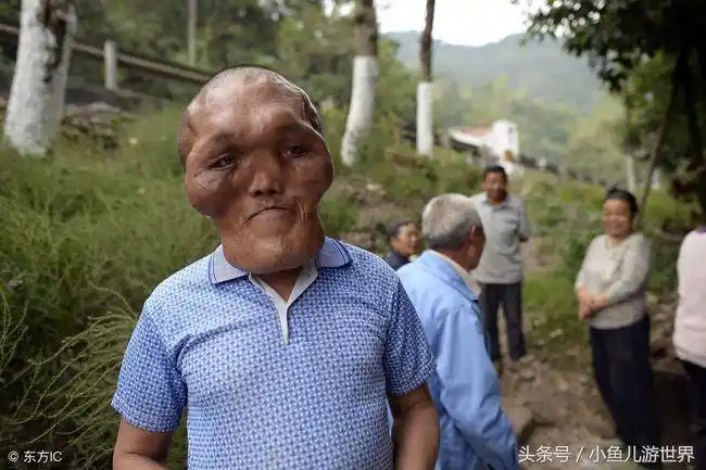 重庆农村大哥基因突变,13岁脑袋变大,视力下降耳朵失聪,怎么了?