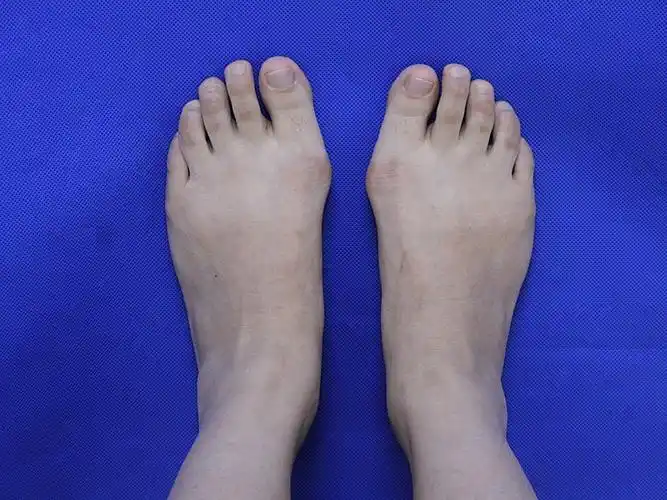 术前我是最近两年才发现自己有拇外翻的,也就是大家常_圈子-新氧美容
