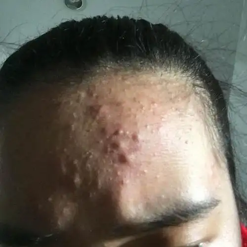 额头长包 总长这样的痘痘 里面是油脂 好像黑头 白色的小颗粒 这样的