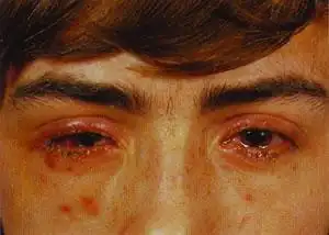 溃疡性睑缘炎(一)眼睑奇痒,疼痛.