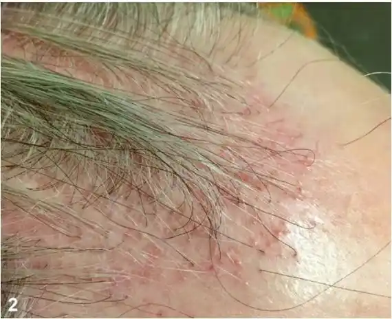 病例挑战:头皮毛囊性红斑和丘疹 [病例帖]