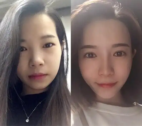我自己的双眼皮77鼻子77全面部脂肪填充两次前后对比照片
