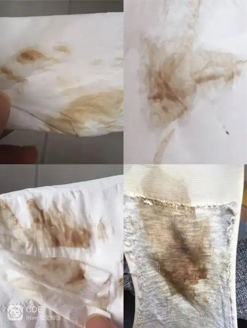 连续7天,白带都是深褐色,怎么回事呀