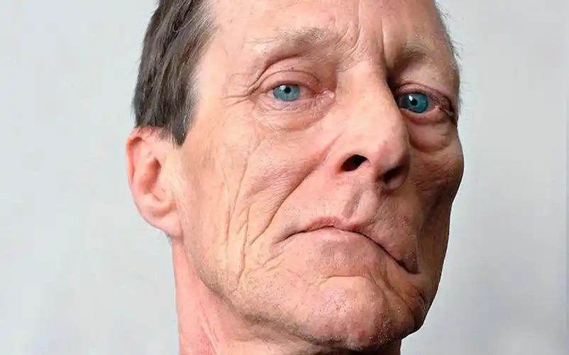 北京广济面神经医院王淑平:面瘫能彻底治好吗?