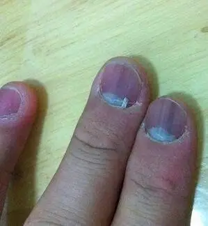 七,指甲发紫 气血的顺利循行与肝有关.