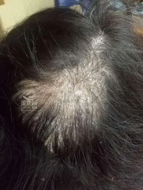 头皮屑太多隔一天不洗头就痒有什么好的办法呢