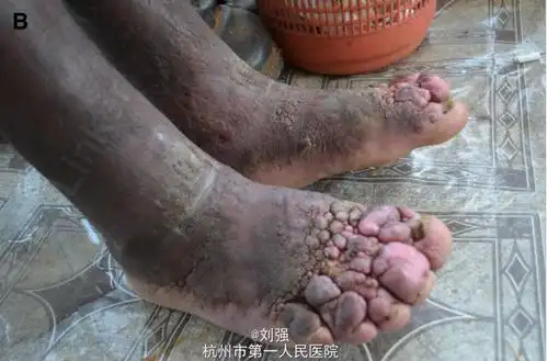 诊断 处理 诊断:地方性非丝虫感染性象皮腿,淋巴水肿(Ⅲ期); 治疗