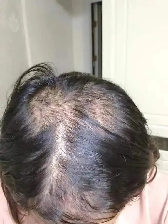 生发皂,配合做的生发yao(纯中药)整整一个月,把几年的脱发问题解决了