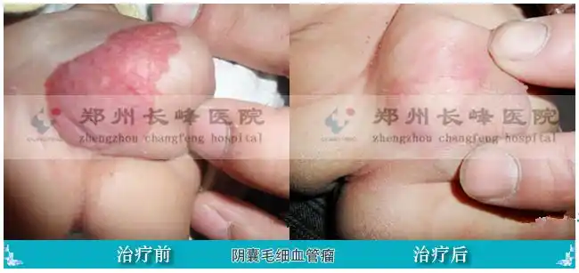 1个多月大的孩子阴囊上长了血管瘤怎么办