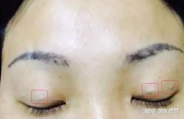 上图来源网络4,过敏等不良反应:做埋线双眼皮为保证手术效果大都