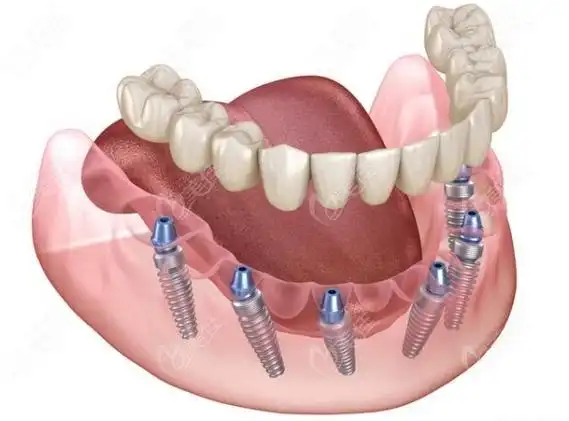 半口种植牙示意图