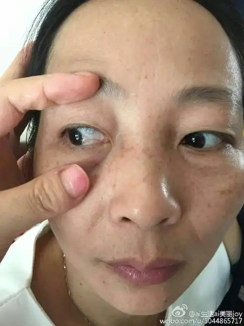 昨天眼睛胬肉的顾客体验后直接带着一个疗程