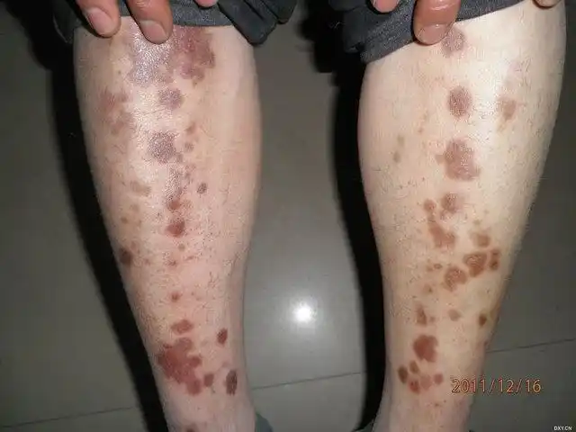 【病例讨论】双下肢红斑 [病例帖]