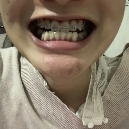 5号拔了左边上下四号牙 - 虎牙矫正 - 牙齿矫正人气社区-牙套之家app