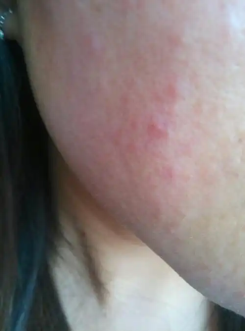 脸上发红,起红疹,有小白水泡,医院说过敏性皮炎治疗了一个月也没好,有