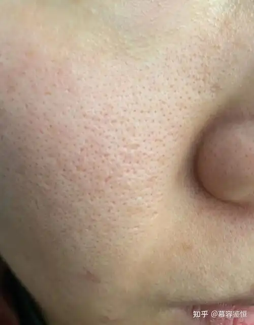 鼻子毛孔粗大怎么修复?