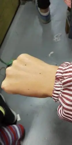 右手背上的三颗痣,三角形代表什么?