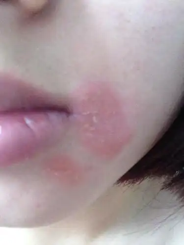 皮肤红肿痒,特别是晚上自己就会抓,起皮会扩散,已经一个月了到底是