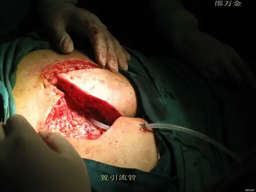 【原创】藏毛窦切除菱形皮瓣成型术(改良limberg手术) [精华]