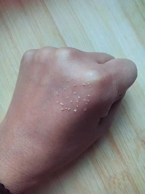 脸上过一段时间就会挤出这样的小颗粒,怎么回事,而且毛孔粗大.