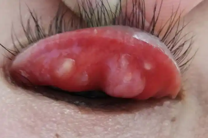 霰粒肿翻开眼皮图片