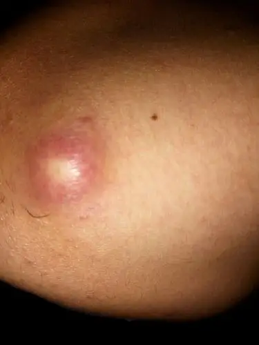 下巴上长了个这个.是什么东西啊.怎么办?